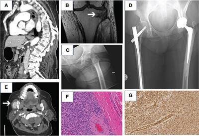 Prolonged Hypophosphatemia and Intensive Care After Curative Surgery of Tumor Induced Osteomalacia: A Case Report